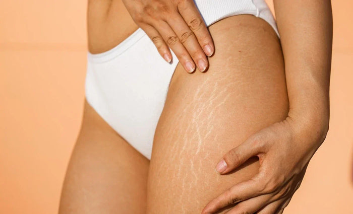 Red Light Therapy for Stretch Marks: A Gentle Way to Restore Skin Confidence